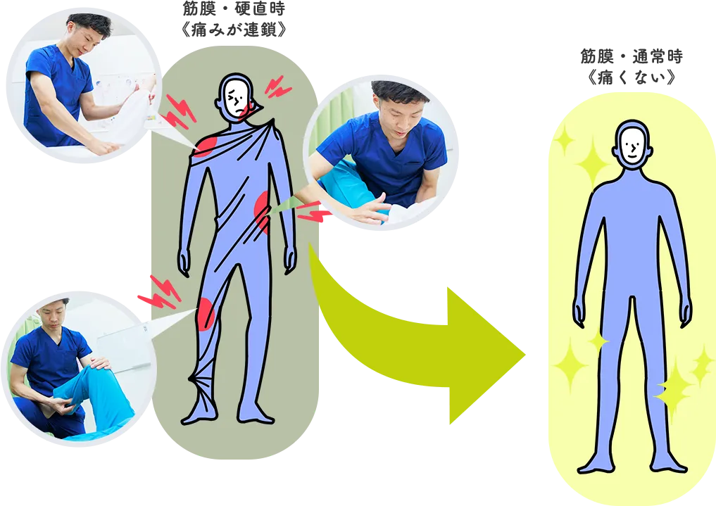ストレスが筋膜を硬くし、痛みや可動制限に繋がる流れの図解