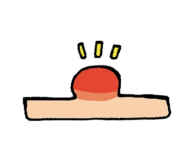 足底筋膜炎（足底腱膜炎）