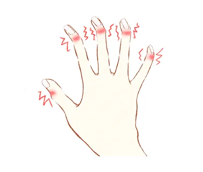 へバーデン結節